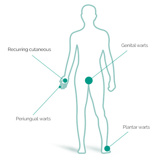 Verrutop, Vortemiddel, æske à 4 ampuller