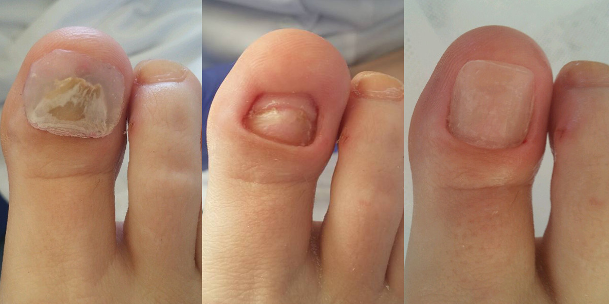 Unguisan, Negleopbygning, pulver, 30 ml