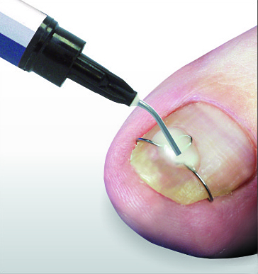 Unguisan, Blue Light, Standard Gel, 3 ml.