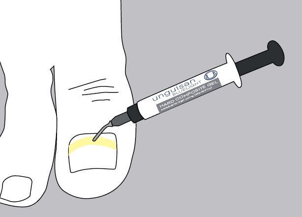 Unguisan, Composit, Hard