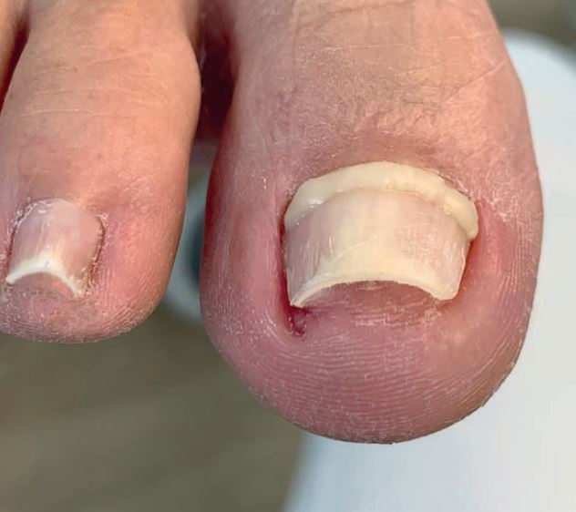 Unguisan, Composit, Hard